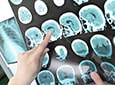где оперируют опухоль головного мозга - нейрохирургическое отделение ЦКБ